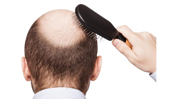 গরমে কীভাবে নেবেন টাক মাথার যত্ন?